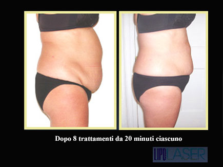 Lipolaser Duo